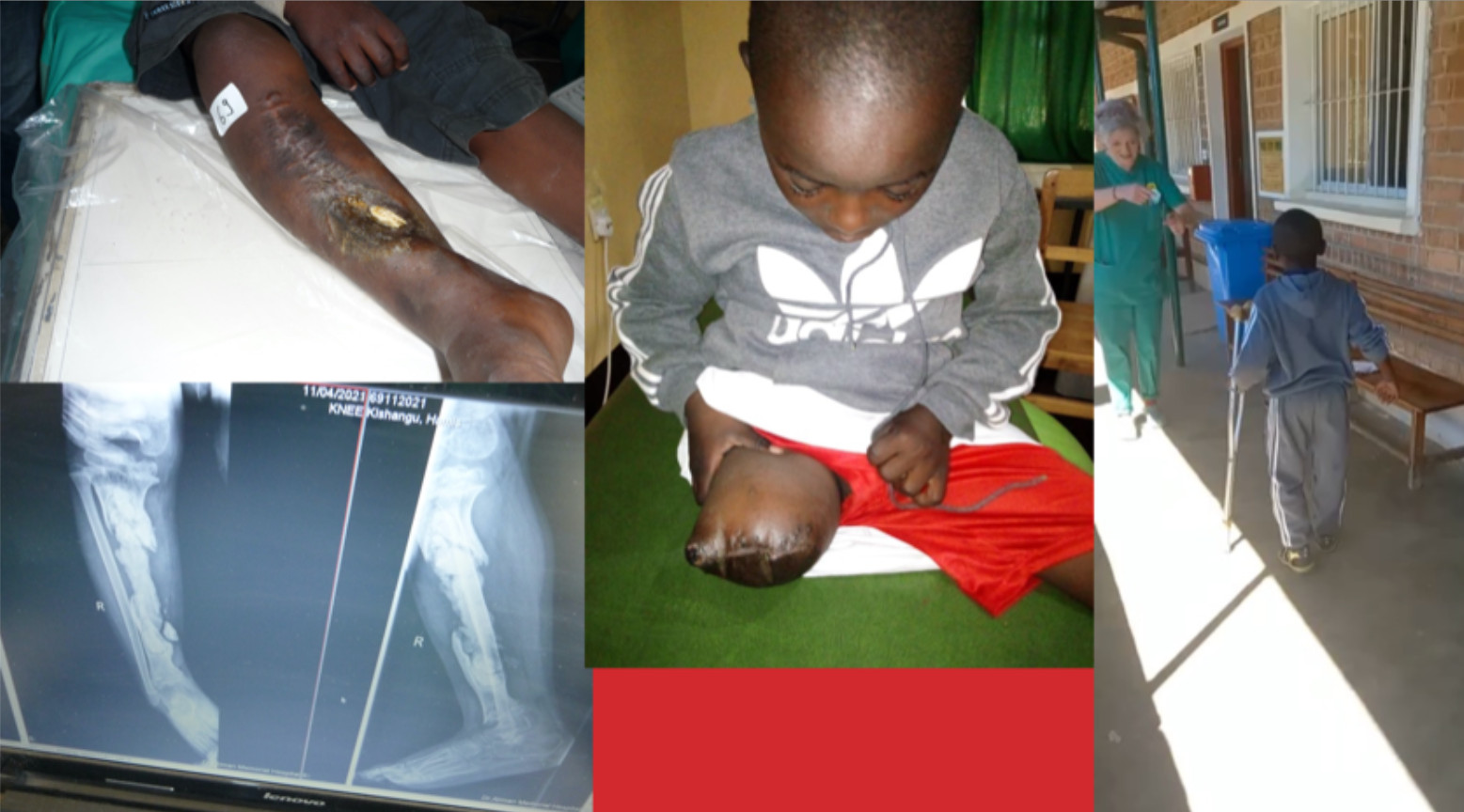 Hamisi, 5 Jahre, Osteomyelitis, nach konservativer 2-jähriger Behandlung, Amputation, Prothese