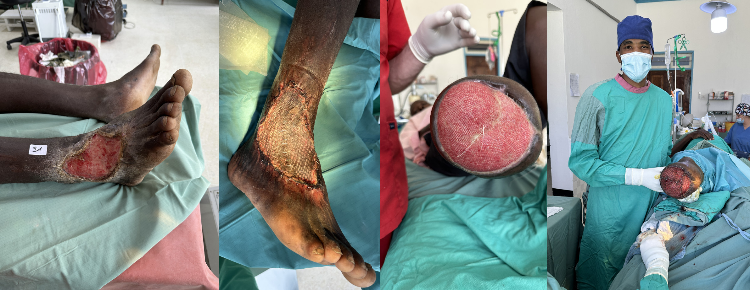 Dr Yusuf Magaka nach erfolgreicher SkinGrafting-OP in eigener Regie